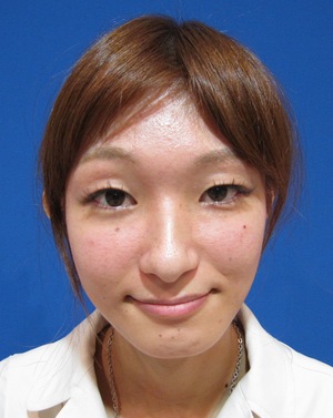 目の下のたるみ、目のくまでお悩みの方、切らずに完璧に解決します。TCB-R法　手術直後　症例写真